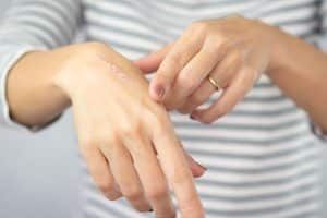 Hand Scarring 